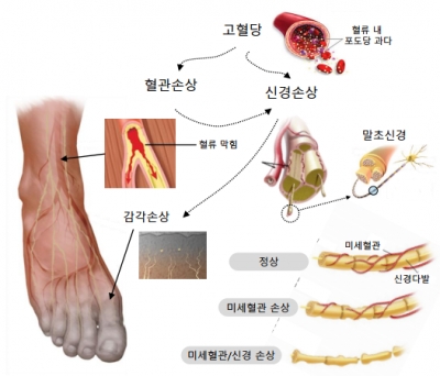 ▲당뇨병성 신경병증(DPN)은 미세혈관과 신경손상으로 통증을 유발한다(△바이로메드 제공)