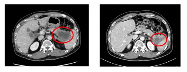 ▲간으로 전이가 진행된 말기 췌장암 환자(59·남)에게 리아백스주를 활용해 항암요법을 진행한 경과를 담은 CT사진. 암소의 크기가 7cm에서 4.4cm로 줄어들었다. 젬백스앤카엘 제공.
