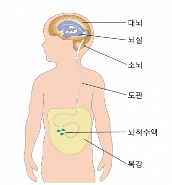 ▲뇌척수액의 흐름을 복강으로 이어주는 션트수술