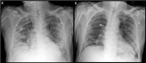 ▲김모씨가 혈장치료를 받기 전(왼쪽)과 후(오른쪽)의 흉부 X-ray 영상. 혈장치료 후 폐렴 등으로 뿌옇게 보이던 폐가 나아지고 있다. 세브란스병원 제공.