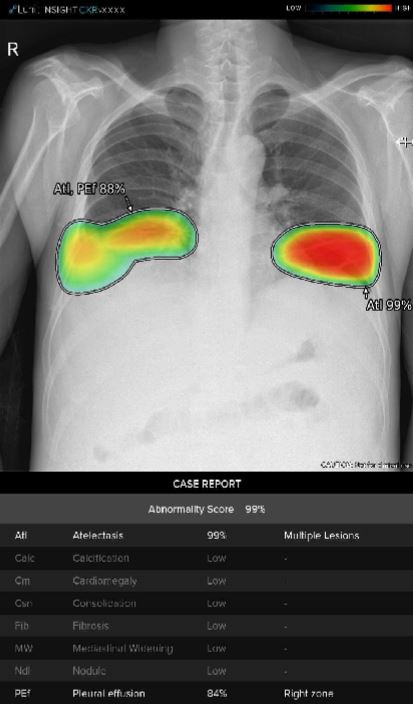 ▲▲GE와 루닛의 합작으로 탄생한 인공지능 기반 엑스레이 분석 솔루션 ‘흉부 케어 스위트(Thoracic Care Suite)’에서 공개한 분석 리포트 샘플 모습