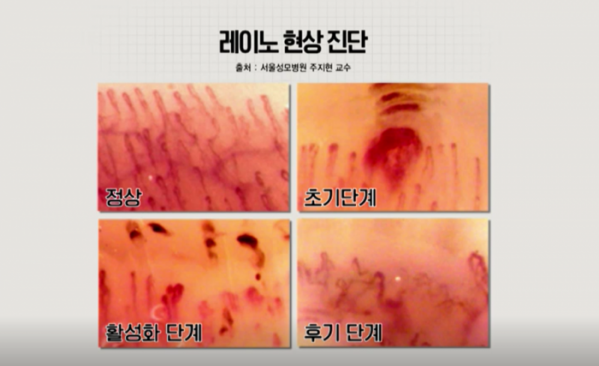 ▲'생로병사의 비밀'(사진제공=KBS 1TV)