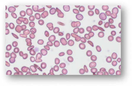 ▲겸상적혈구병(SCD) 환자들의 적혈구 현미경 사진 (GBT 발표자료)