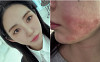 AOA 출신 권민아,  피부 시술 중 화상 피해⋯"합의 제안했다가 협박범으로 몰려"