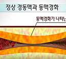 최재철 교수가 전하는 여름철 뇌졸중의 전조증상 및 골든타임 지키는 법(명의)