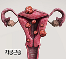 자궁근종ㆍ자궁내막증ㆍ자궁선근증, 여성 가임력에 켜진 적신호(생로병사의 비밀)