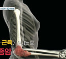 '명의' 전대근 교수가 전하는 육종암의 종류 및 치료법