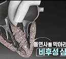 '생로병사의 비밀' 돌연사 부르는 비후성 심근증