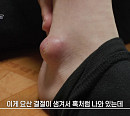 '생로병사의 비밀' 통풍 관리법