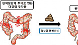 면역항암제 부작용 대장염, 분변이식으로 치료 “첫 사례”