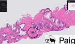 페이지, 전립선암 'AI 병리진단' 