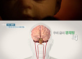 'EBS 명의' 신경외과 안재성 교수가 말하는 뇌동맥류의 진단과 증상, 치료 방법