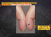 '핑거클러빙', '옥탑방'서 소개한 손가락 폐암 자가 진단법
