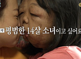 '신경섬유종증', 시력마저 잃어가는 14세 소녀 여진이