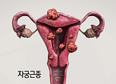 자궁근종ㆍ자궁내막증ㆍ자궁선근증, 여성 가임력에 켜진 적신호(생로병사의 비밀)