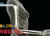 '명의' 전대근 교수가 전하는 육종암의 종류 및 치료법