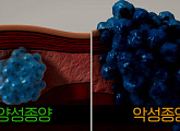양성종양과 암 가르는 몸 속의 혹(생로병사의 비밀)