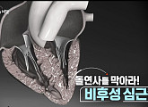 '생로병사의 비밀' 돌연사 부르는 비후성 심근증