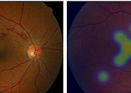 "눈건강 이상 여부 이제 딥러닝 알고리즘이 알려준다"