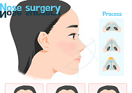 코성형 트렌드, 이목구비 조화 감안한 '토탈노즈' 성형 선호도 높아