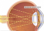 안개가 낀듯 눈앞이 침침… 백내장 ‘나이 상관없다’