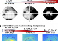 정상안압 녹내장 조기 진단 바이오마커 제시…적극 치료에 도움