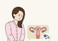 ‘여성의 감기’ 질염 다 같은 건 아니다…원인·증상 다양