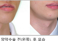주걱턱 양악 수술 후 재발 가능성 예측 모델 개발