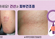 겨울만 되면 가려운 피부…‘건선’일까 ‘피부건조증’일까? [e건강~쏙]