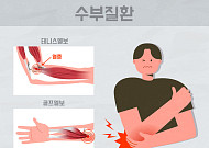팔꿈치 안팎으로 쑤신다면…테니스·골프엘보 주의 [e건강~쏙]