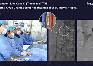 서울성모병원, 국내 첫 경대정맥 대동맥 판막 치환술 실시