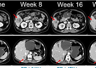 한미약품, 흑색종 항암신약 ‘벨바라페닙’ 임상 2상 첫 환자 투약
