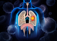 “폐암, 조기 발견이 핵심…수술 후 재발 관리 ‘골든타임’ 중요”