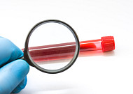 갑자기 찾아오는 ‘급성골수성백혈병’…조기 진단이 관건[e건강~쏙]