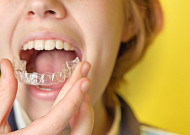 치아교정에도 ‘골든타임’…“7세 첫 검진, 평생 치열 좌우”[e건강~쏙]