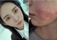 AOA 출신 권민아,  피부 시술 중 화상 피해⋯"합의 제안했다가 협박범으로 몰려"