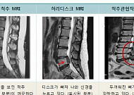 [100세까지 건강하게]노년기 척추질환 척추협착증, <b>허리</b>디스크와 구분하는 방법은?