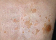 여름철 어루러기 주의보, 알고보니 피부 곰팡이…남성이 두 배 많은 이유는?