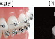 치아, 급속교정과 라미네이트의 차이