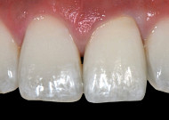 [장수건강 치아에 달렸다 Part 5] 더 진짜 같은 가짜 치아의 세계