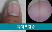 '손발톱 검은선'으로 암 진단 가능?…선 너비 3mm 이상일 경우 '위험'