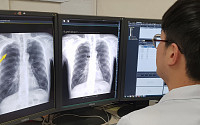 서울대병원, 인공지능으로 폐암 조기 진단 정확도 높여