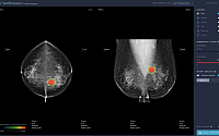 루닛, 유방암 진단 보조 AI 소프트웨어 식약처 허가 획득