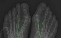 [헬스TALK] 엄지발가락의 변형으로 오는 '무지외반증'...발가락 교정기 효과는 '글쎄'