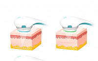 일상생활 지장 없이 주름 개선하는 리프팅레이저 '슈링크'