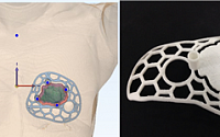 유방암 환자 맞춤형 3D 가이드 모델로 수술…암, 재발, 부작용 없어