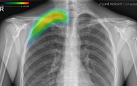 루닛, 주요 폐 질환 검출 AI ‘루닛 인사이트 CXR 2’ 식약처 허가