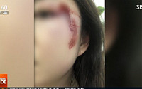 서울역 묻지마 폭행, 어깨 일부러 부딪힌 후 얼굴 가격→광대뼈 골절…네티즌 '분노'