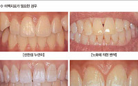 [즐거운 치과의 건강한 치아 만들기] 사랑스런 미소 만들어주는 치아미백
