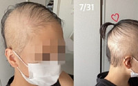 모더나 부작용은 대머리?...일본 20대 여성 백신 접종 후 심각한 '탈모' 호소